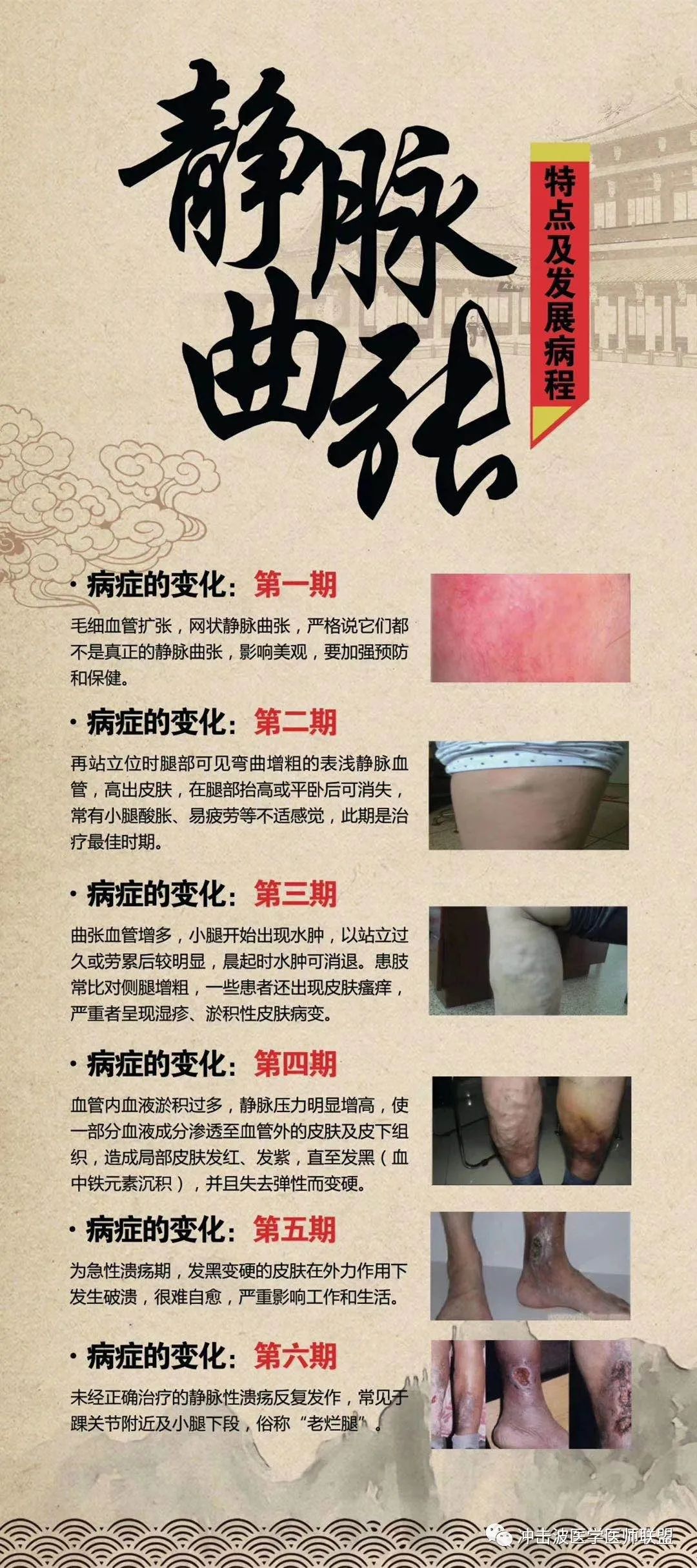 靜脈曲張新療法觀點(diǎn)論述與解析