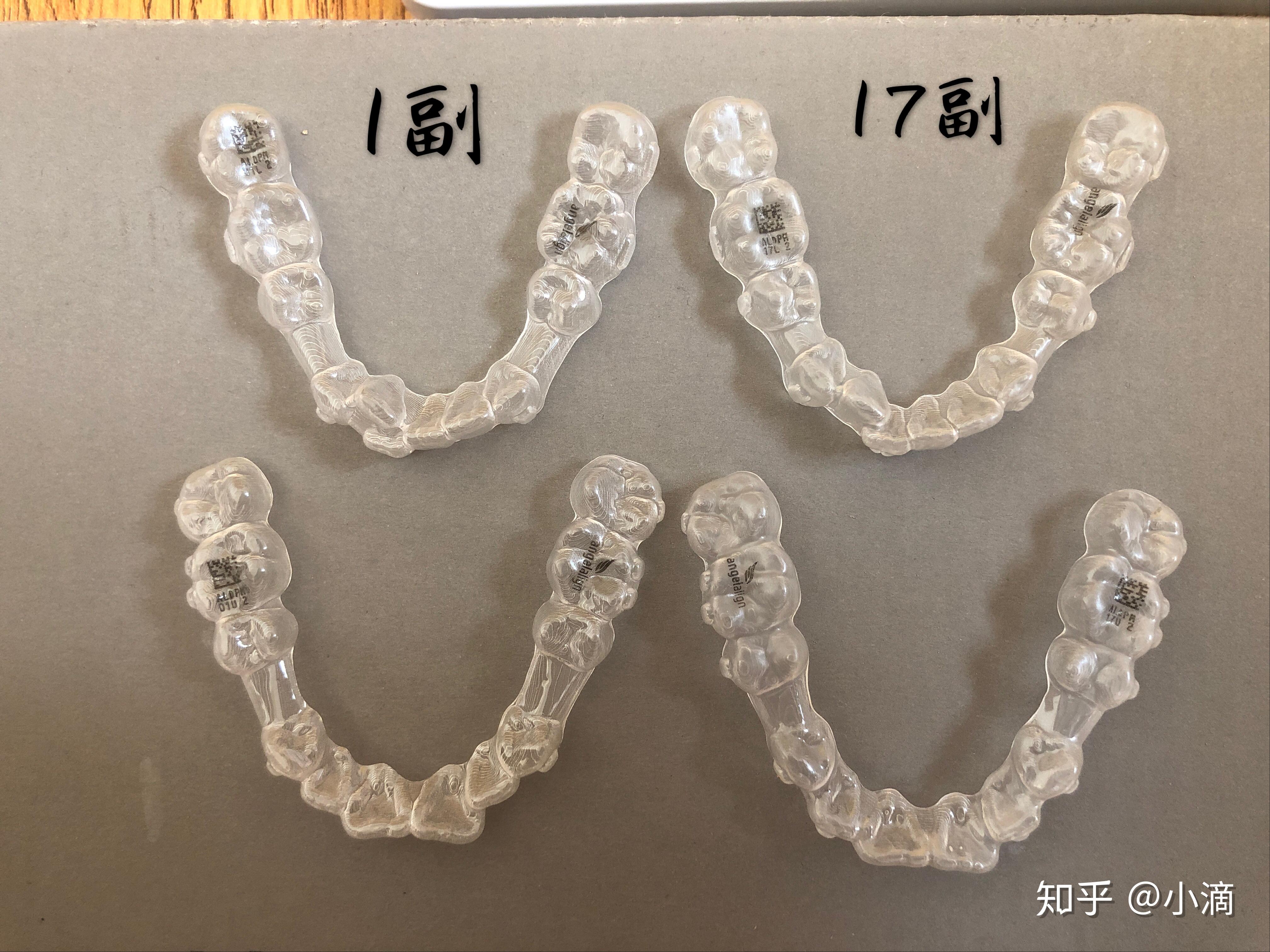 時代天使牙套價格揭秘，小巷中的美麗蛻變之旅啟動！