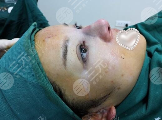 最新隆鼻手術(shù)，重塑鼻型，找回自信